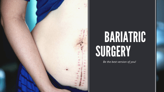 Get Bariatric Surgery Loan Today For A Better Transformation